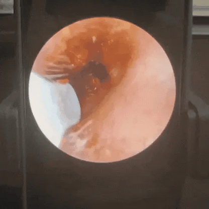 OTOSCOPE EARO – HYGIÈNE AUDITIVE REVOULTIONÉE - Earo